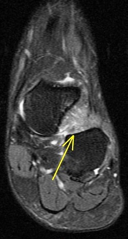 Figure 2 for case Sinus tarsi ligament sprains